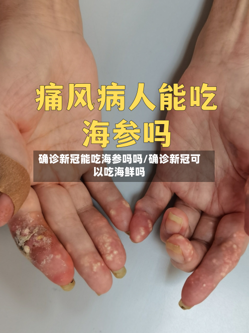 确诊新冠能吃海参吗吗/确诊新冠可以吃海鲜吗-第2张图片