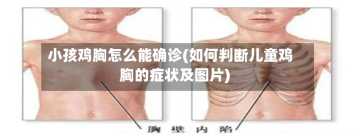 小孩鸡胸怎么能确诊(如何判断儿童鸡胸的症状及图片)-第2张图片