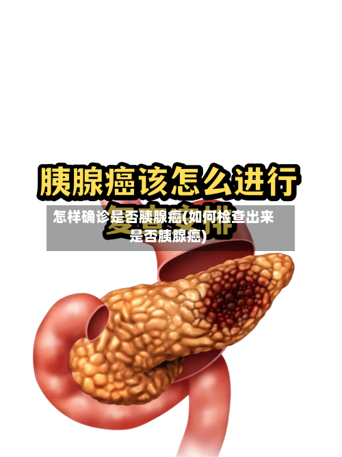 怎样确诊是否胰腺癌(如何检查出来是否胰腺癌)