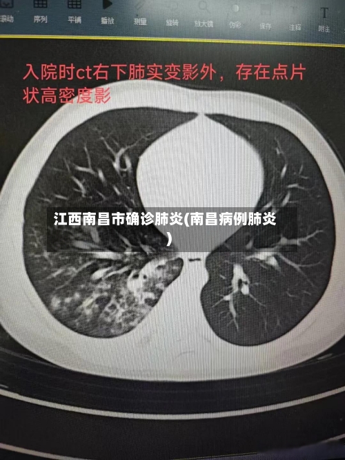 江西南昌市确诊肺炎(南昌病例肺炎)-第2张图片