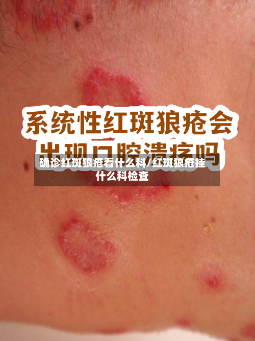 确诊红斑狼疮看什么科/红斑狼疮挂什么科检查