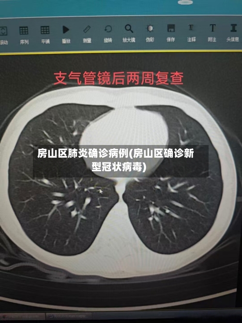 房山区肺炎确诊病例(房山区确诊新型冠状病毒)