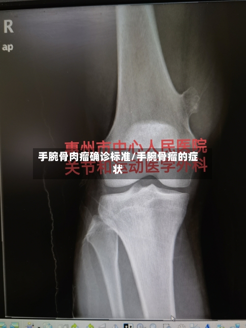 手腕骨肉瘤确诊标准/手腕骨瘤的症状