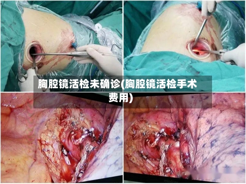 胸腔镜活检未确诊(胸腔镜活检手术费用)