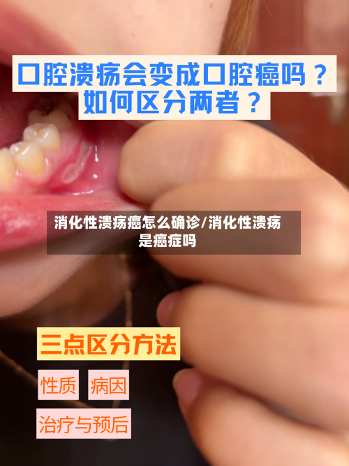 消化性溃疡癌怎么确诊/消化性溃疡是癌症吗-第3张图片