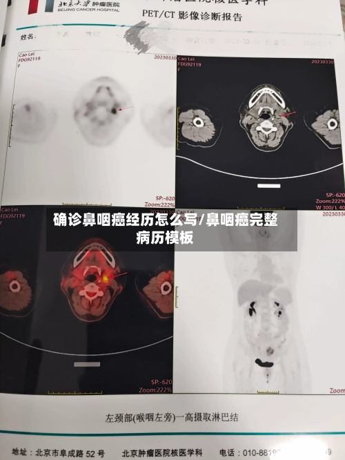 确诊鼻咽癌经历怎么写/鼻咽癌完整病历模板-第2张图片