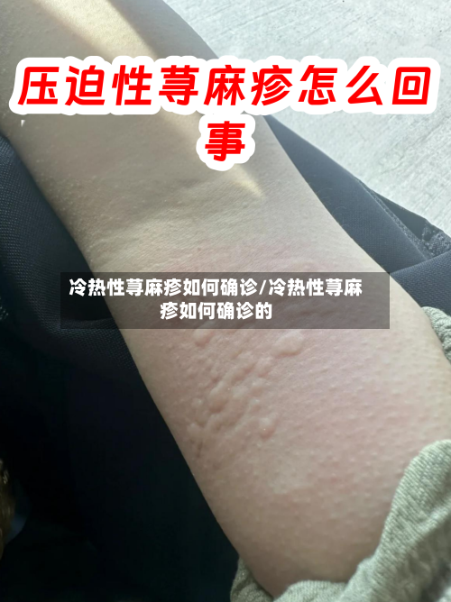 冷热性荨麻疹如何确诊/冷热性荨麻疹如何确诊的