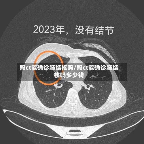 照ct能确诊肺结核吗/照ct能确诊肺结核吗多少钱
