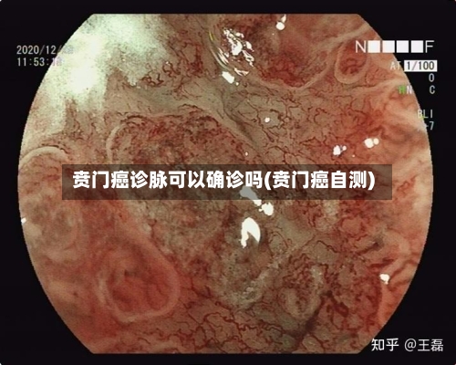 贲门癌诊脉可以确诊吗(贲门癌自测)-第2张图片